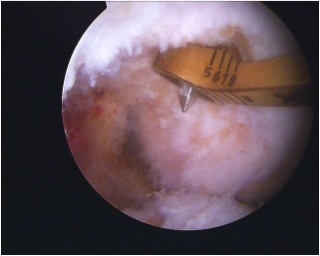 PCL Femur